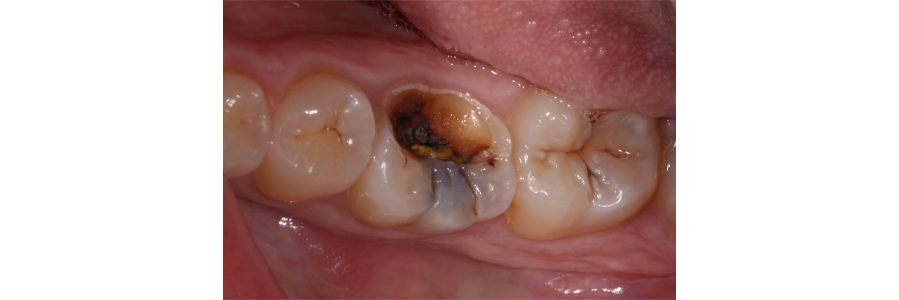 Modern Materials for Pulpal Protection Digest ModernMaterialsforPulpalProtection IMG1