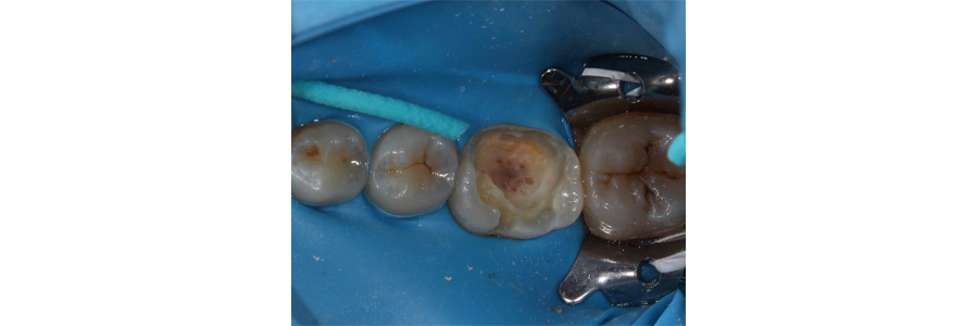 Modern Materials for Pulpal Protection Digest ModernMaterialsforPulpalProtection IMG2