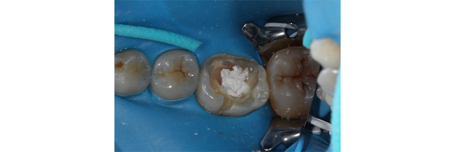 Modern Materials for Pulpal Protection Digest ModernMaterialsforPulpalProtection IMG3