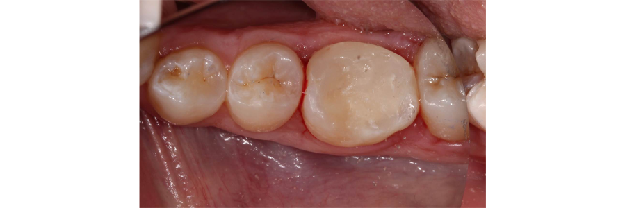 Modern Materials for Pulpal Protection Digest ModernMaterialsforPulpalProtection IMG4