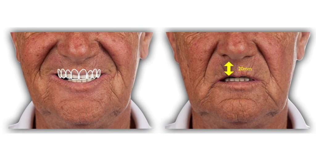 Options for Determining Vertical Dimension with Edentulous Patients, Part 2 Darin Dichter VerticalDimensionwithEdentulousPatients 3