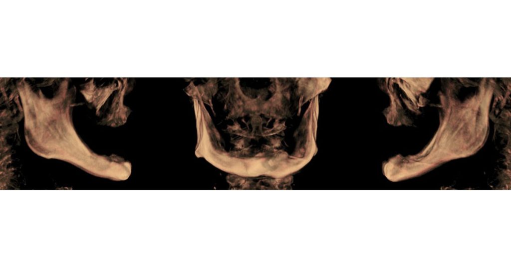 Options for Determining Vertical Dimension with Edentulous Patients, Part 2 Darin Dichter VerticalDimensionwithEdentulousPatients 4