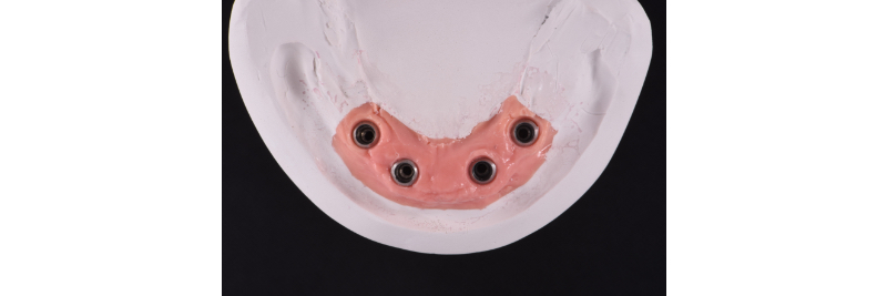 The Use of a Plaster Verification Jig to Ensure Accuracy of the Master Cast Jig Mitrani use plaster verification jig 01 2