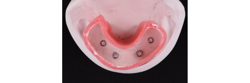 The Use of a Plaster Verification Jig to Ensure Accuracy of the Master Cast Jig Mitrani use plaster verification jig 02