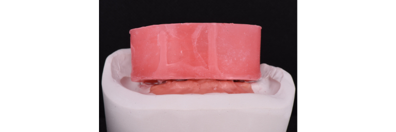 The Use of a Plaster Verification Jig to Ensure Accuracy of the Master Cast Jig Mitrani use plaster verification jig 03