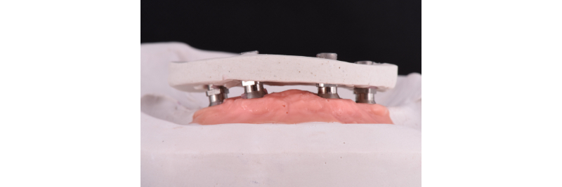 The Use of a Plaster Verification Jig to Ensure Accuracy of the Master Cast Jig Mitrani use plaster verification jig 04