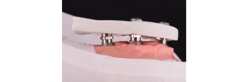 The Use of a Plaster Verification Jig to Ensure Accuracy of the Master Cast Jig Mitrani use plaster verification jig 05