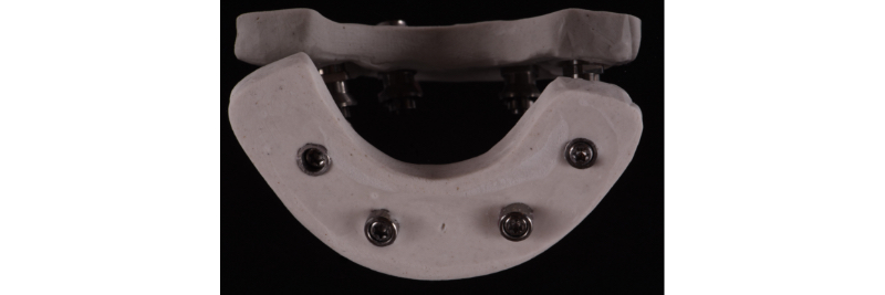 The Use of a Plaster Verification Jig to Ensure Accuracy of the Master Cast Jig Mitrani use plaster verification jig 06