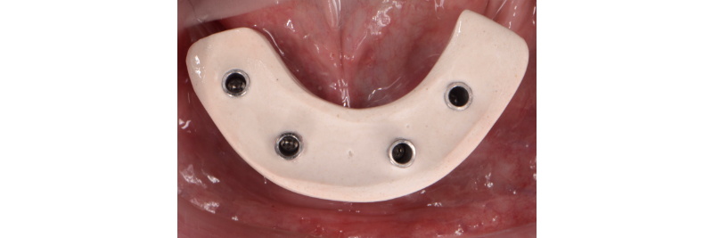 The Use of a Plaster Verification Jig to Ensure Accuracy of the Master Cast Jig Mitrani use plaster verification jig 07