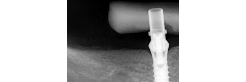 The Use of a Plaster Verification Jig to Ensure Accuracy of the Master Cast Jig Mitrani use plaster verification jig 08