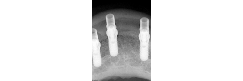 The Use of a Plaster Verification Jig to Ensure Accuracy of the Master Cast Jig Mitrani use plaster verification jig 09