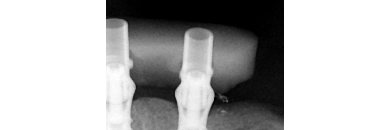 The Use of a Plaster Verification Jig to Ensure Accuracy of the Master Cast Jig Mitrani use plaster verification jig 10