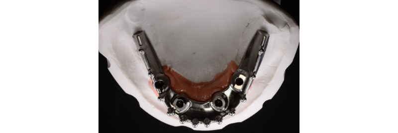 The Use of a Plaster Verification Jig to Ensure Accuracy of the Master Cast Jig Mitrani use plaster verification jig 11