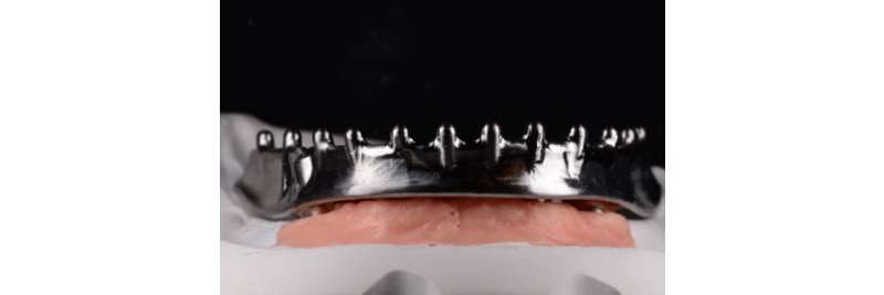 The Use of a Plaster Verification Jig to Ensure Accuracy of the Master Cast Jig Mitrani use plaster verification jig 12