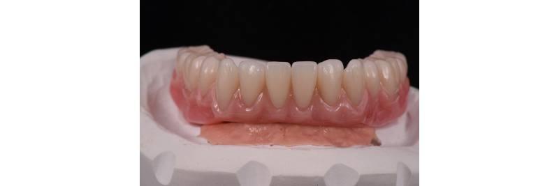 The Use of a Plaster Verification Jig to Ensure Accuracy of the Master Cast Jig Mitrani use plaster verification jig 14