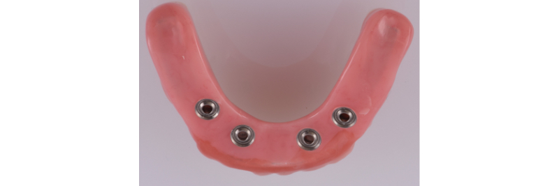 The Use of a Plaster Verification Jig to Ensure Accuracy of the Master Cast Jig Mitrani use plaster verification jig 17