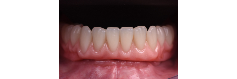 The Use of a Plaster Verification Jig to Ensure Accuracy of the Master Cast Jig Mitrani use plaster verification jig 20