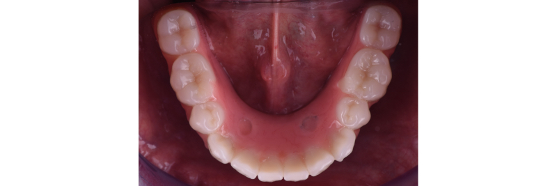 The Use of a Plaster Verification Jig to Ensure Accuracy of the Master Cast Jig Mitrani use plaster verification jig 21