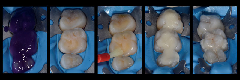 Bonded e.max overlays restoring occlusal surfaces with minimal preparation as part of a conservative interdisciplinary dental treatment approach.