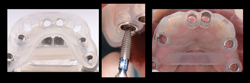 Flapless guided implant surgery demonstrating conservative interdisciplinary dental treatment with minimally invasive techniques.