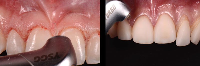 Laser-assisted procedures supporting conservative interdisciplinary dental treatment, including crown lengthening, frenectomy, and veneer removal.
