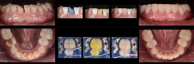 Phased full-arch reconstruction using additive composite techniques within a conservative interdisciplinary dental treatment plan.