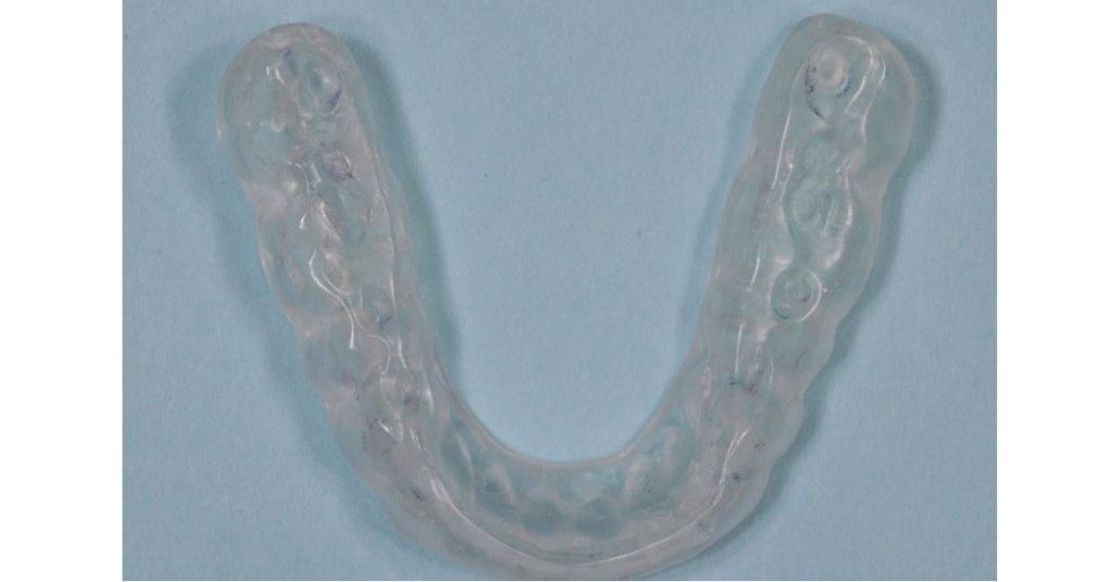 Rouse anterior repositioning appliance 01 1