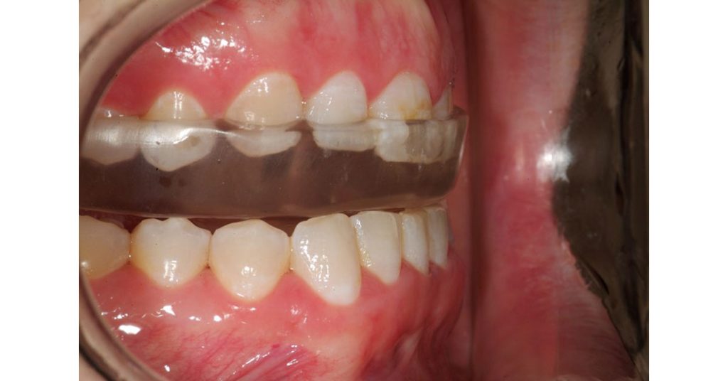 Rouse anterior repositioning appliance 03