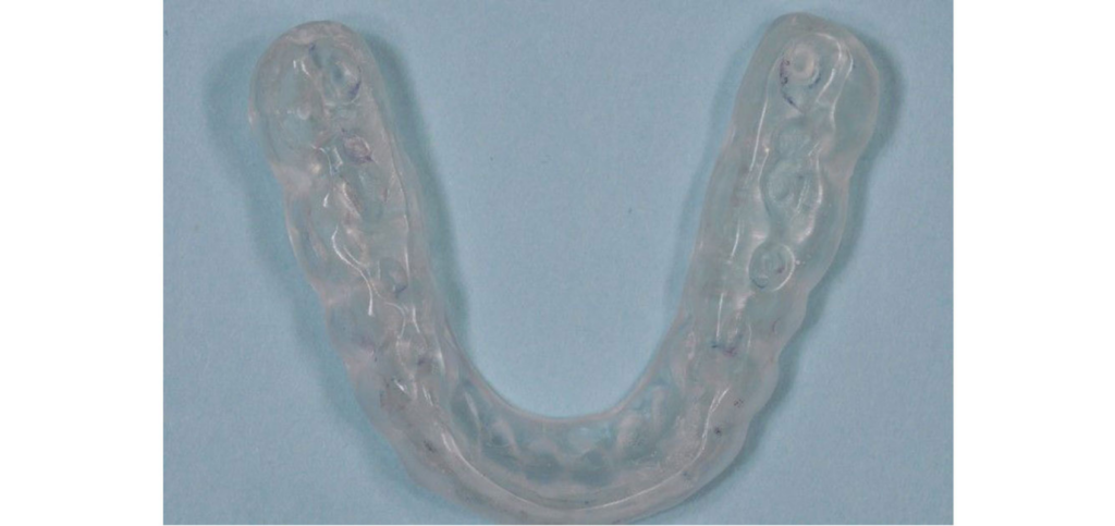 Aspen anterior bite guard demonstrating a maxillary anterior repositioning appliance seated intraorally.