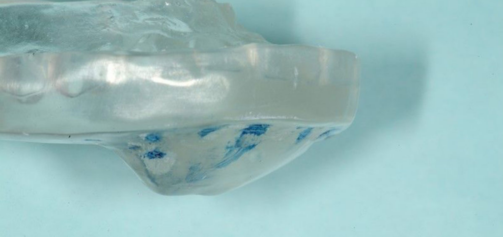 Farrar anterior bite guard showing the anterior repositioning ramp used to guide mandibular positioning