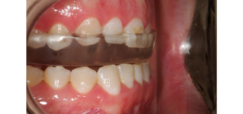 Maxillary anterior bite guard with anterior repositioning indentations viewed from the occlusal surface.