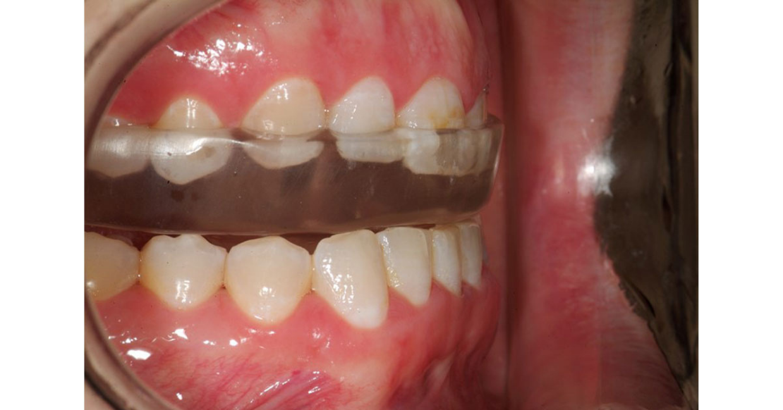 Anterior Bite Guard: The ARA Night Guard You Never Heard Of Maxillary anterior bite guard with anterior repositioning indentations viewed from the occlusal surface.