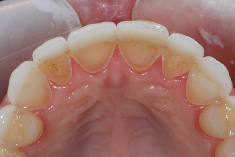 Intrinsic Dental Erosion: Causes and Diagnosis Mitrani intrinsice dental erosion 02