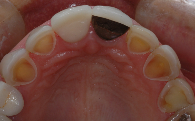 Intrinsic Dental Erosion: Causes and Diagnosis Mitrani intrinsice dental erosion 03