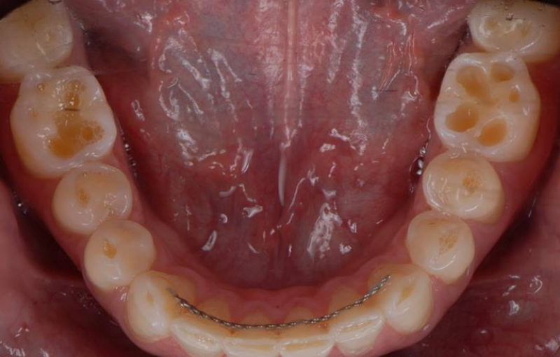 Intrinsic Dental Erosion: Causes and Diagnosis Mitrani intrinsice dental erosion 04