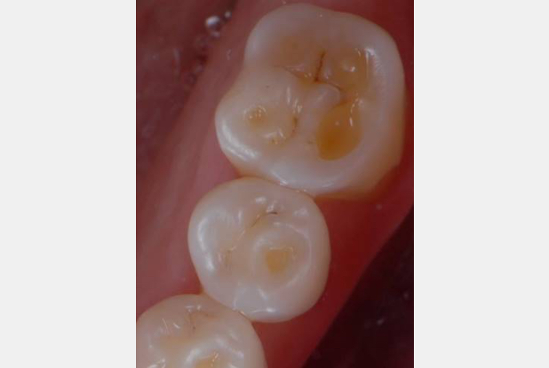 Intrinsic Dental Erosion: Causes and Diagnosis Mitrani intrinsice dental erosion 05