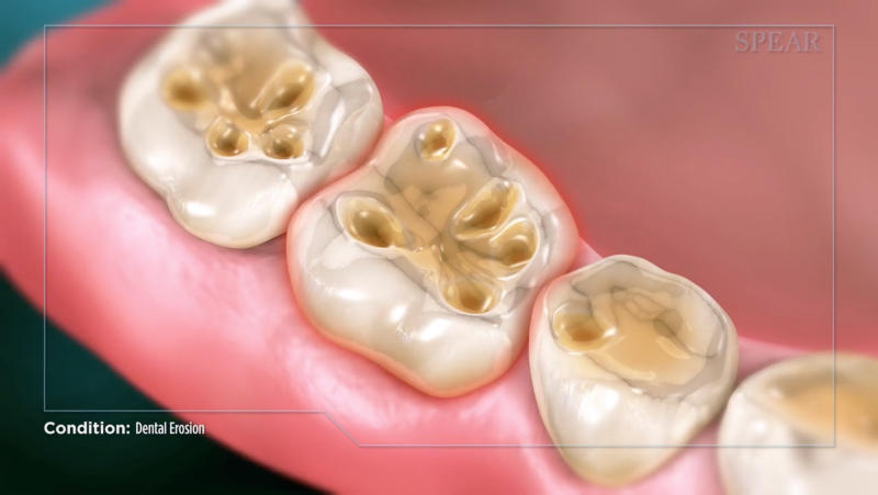 Intrinsic Dental Erosion: Causes and Diagnosis Mitrani intrinsice dental erosion 06