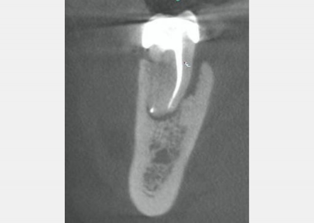 Spear Digest Berman vertical root fractures featured image