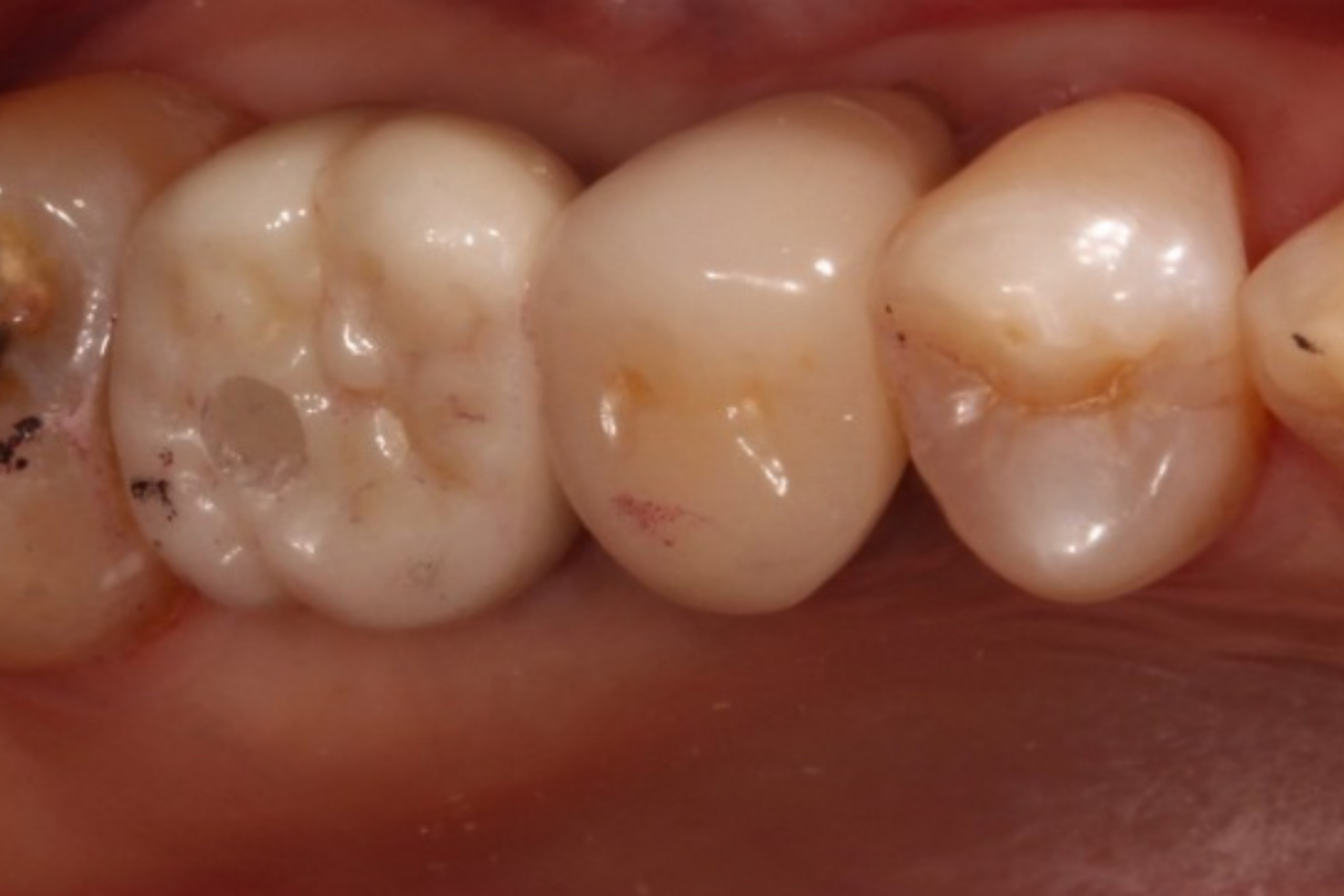 Screw Retained Implant Crown vs Cement-Retained: Which is Best? Screw retained implant crown showing the occlusal screw access channel in a posterior restoration as a hero image.