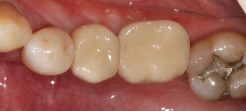 Implant Crowns: Cement, Screw or Both? Janiga implant crowns cement 01 2