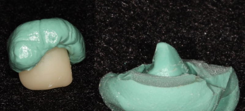 Implant Crowns: Cement, Screw or Both? Janiga implant crowns cement 02 1