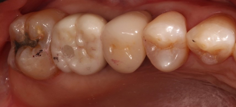Implant Crowns: Cement, Screw or Both? Janiga implant crowns cement 03 1