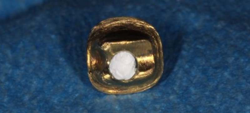 Implant Crowns: Cement, Screw or Both? Janiga implant crowns cement 06