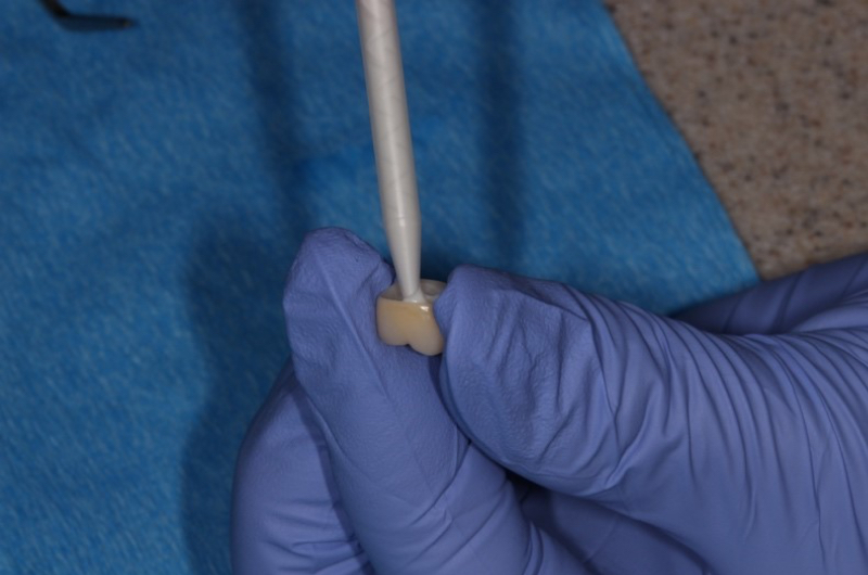 Implant Crowns: Cement, Screw or Both? Janiga implant crowns cement 07