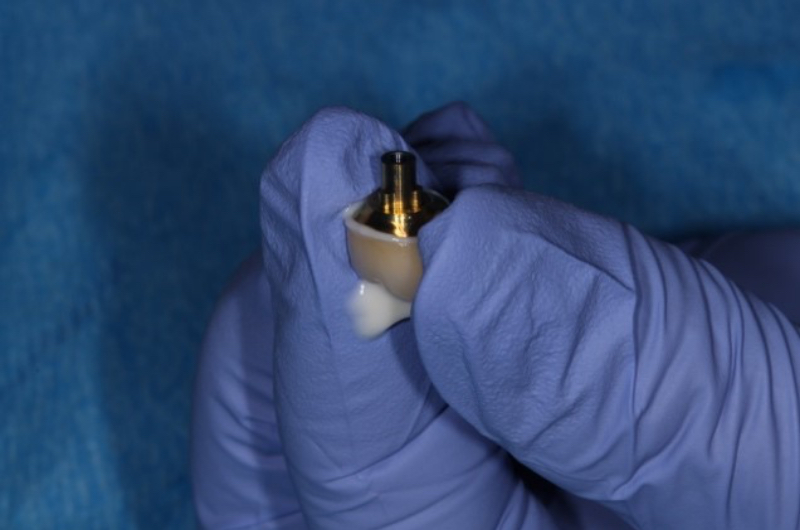 Implant Crowns: Cement, Screw or Both? Janiga implant crowns cement 08