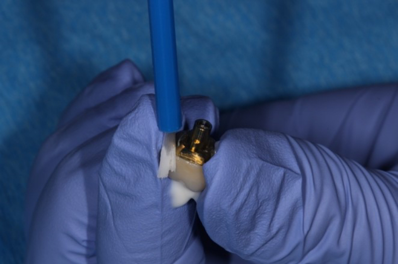 Implant Crowns: Cement, Screw or Both? Janiga implant crowns cement 09