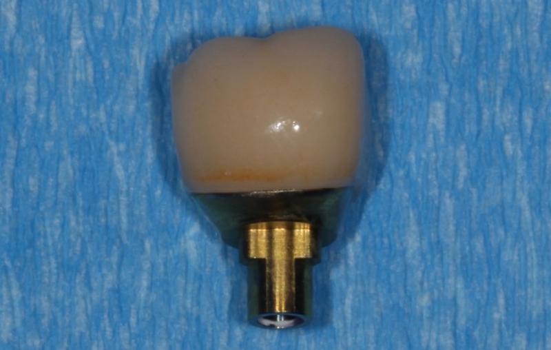 Implant Crowns: Cement, Screw or Both? Janiga implant crowns cement 10