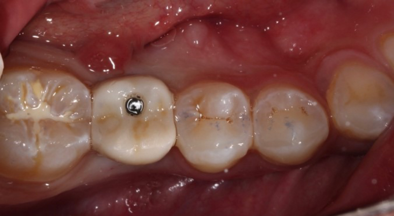 Implant Crowns: Cement, Screw or Both? Janiga implant crowns cement 11