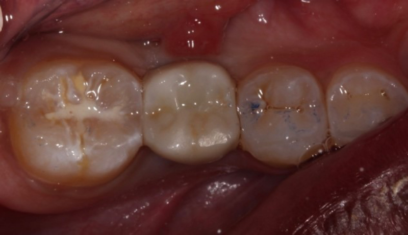 Implant Crowns: Cement, Screw or Both? Janiga implant crowns cement 12