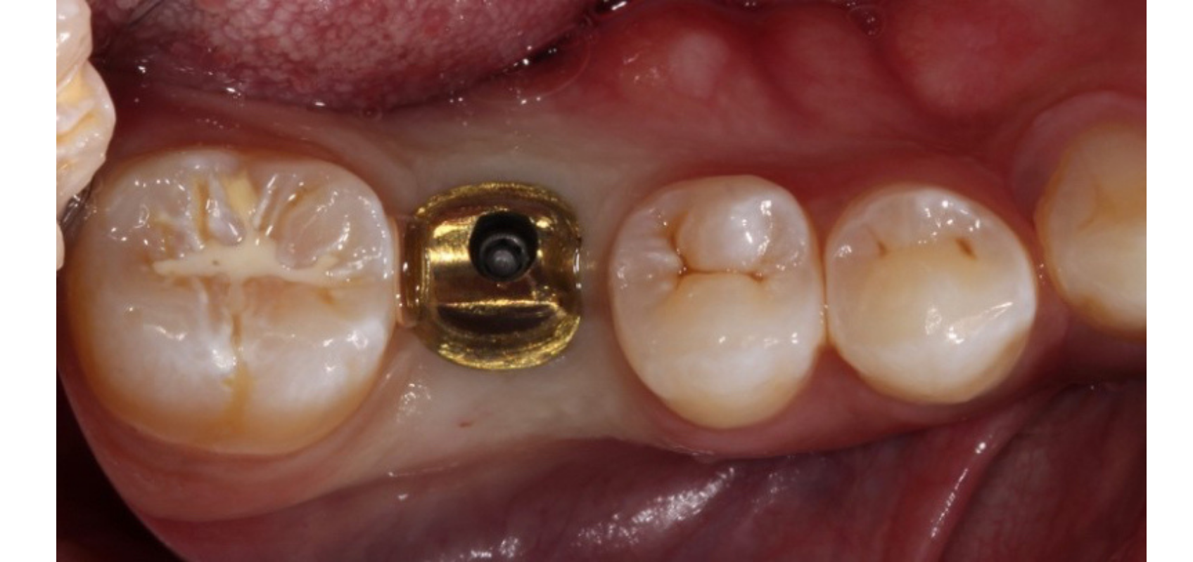 efrver Screw retained implant crown abutment seated intraorally in the posterior mandible before crown cementation